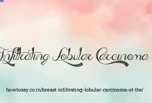 Breast Infiltrating Lobular Carcinoma Of The