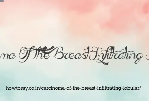 Carcinoma Of The Breast Infiltrating Lobular