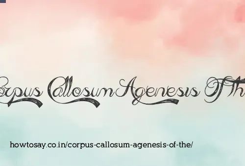 Corpus Callosum Agenesis Of The