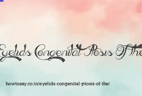 Eyelids Congenital Ptosis Of The
