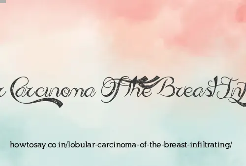 Lobular Carcinoma Of The Breast Infiltrating