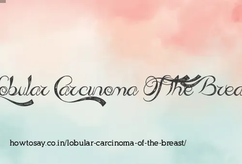 Lobular Carcinoma Of The Breast